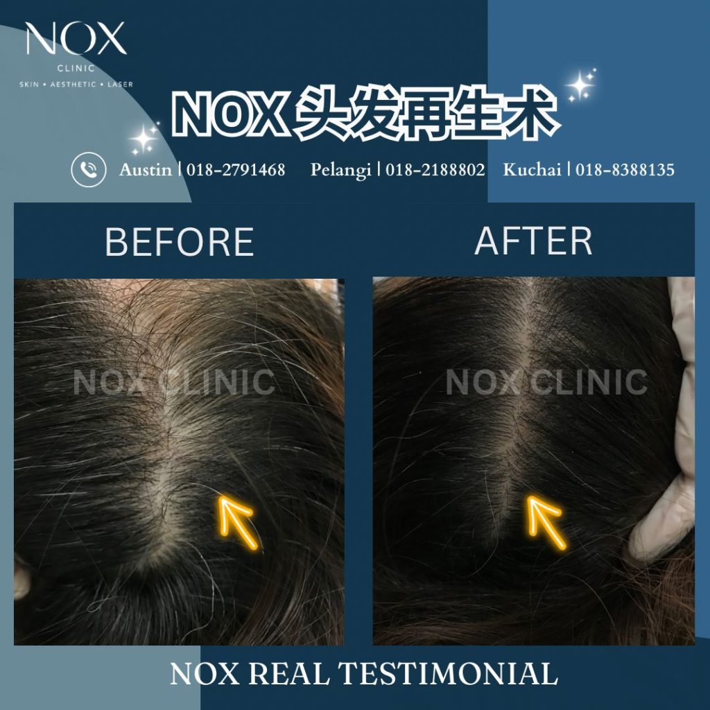 Exosome Hair