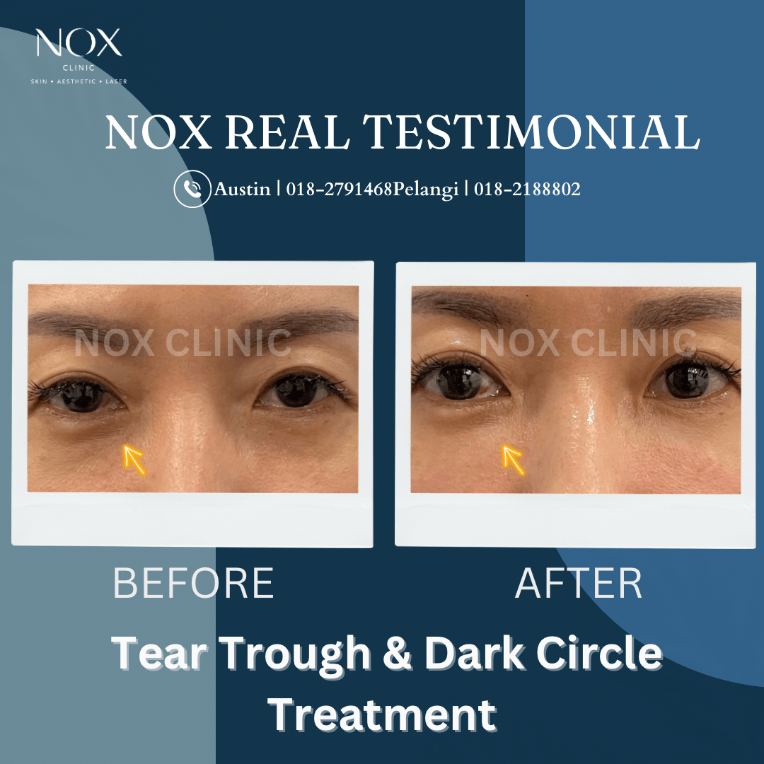 dark circle treatment