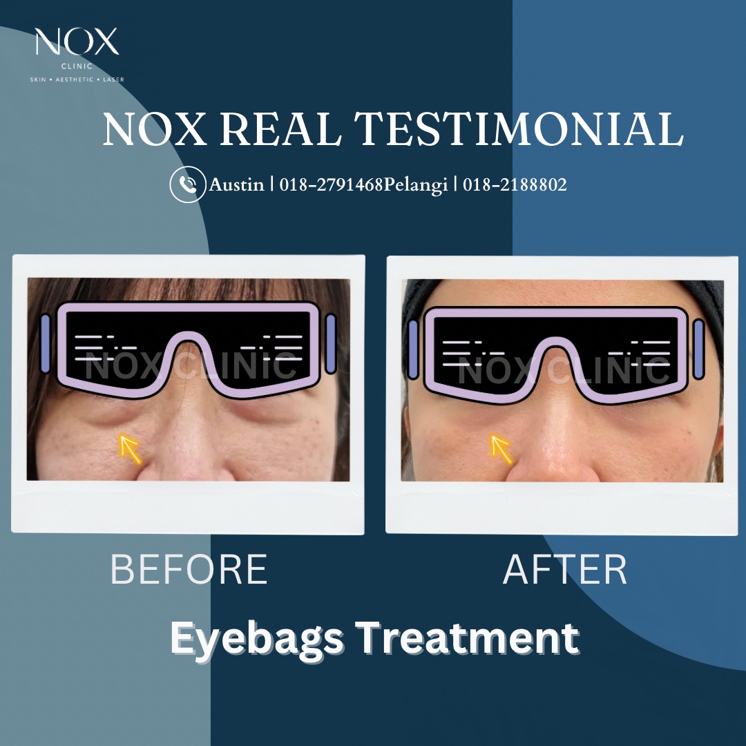 eyebag treatment