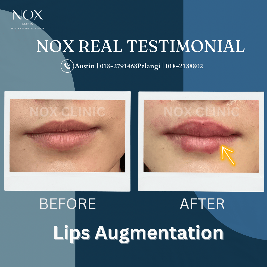 lips augmentation