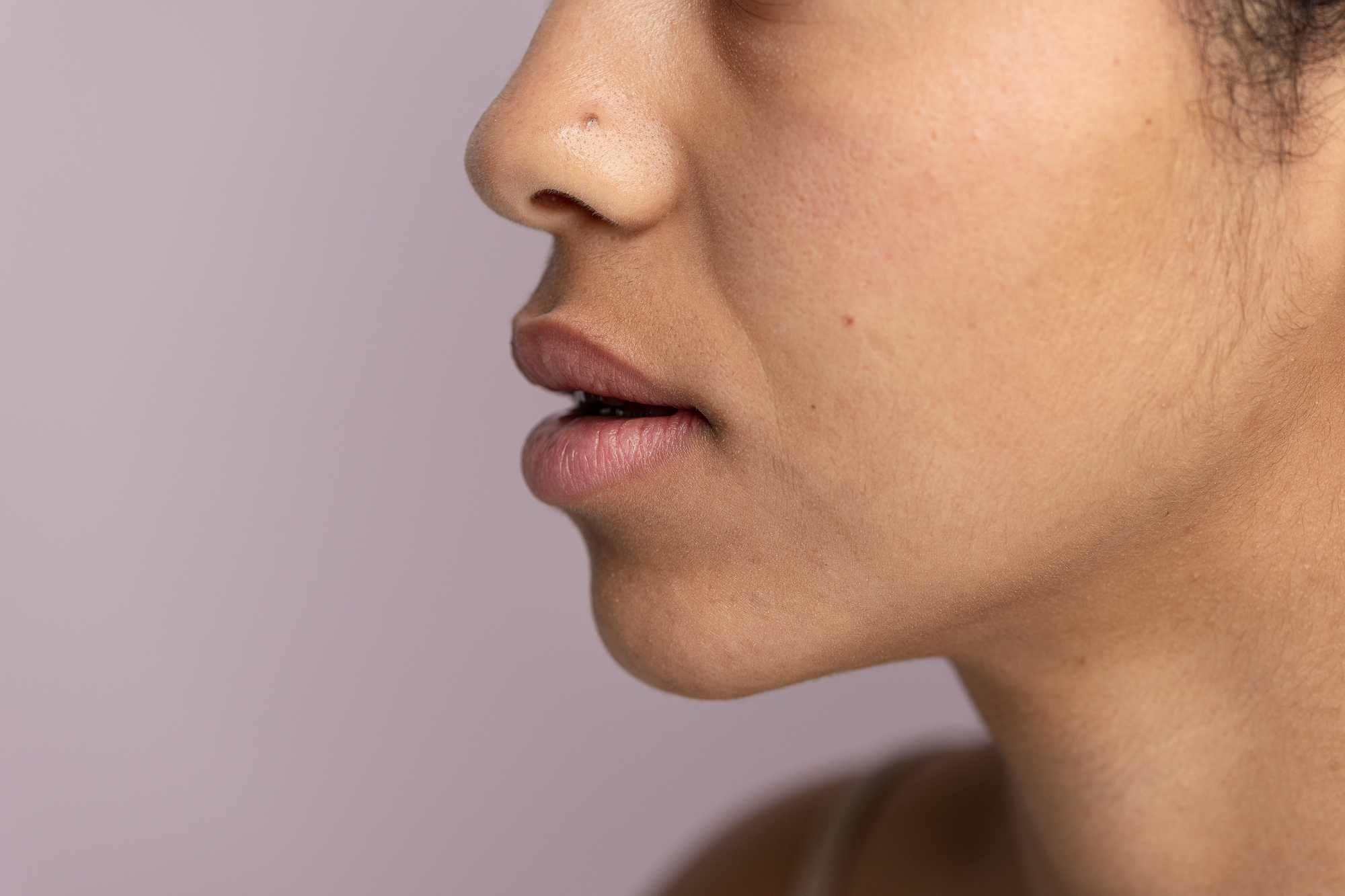 Loss of Cheek Volume