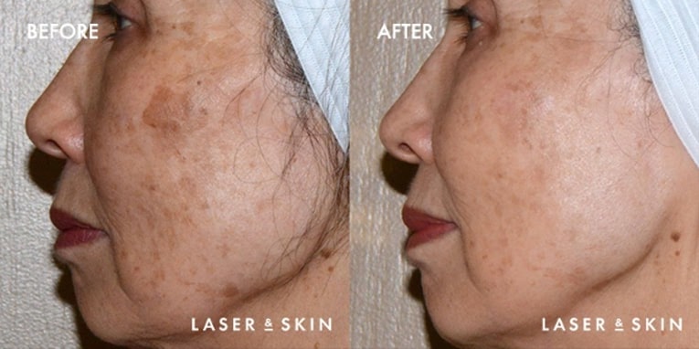 pico laser before after 2