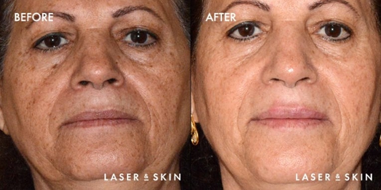 pico laser before after