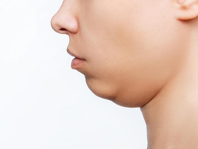 Body Rejuvenation: Double Chin, Neck line, Turkey Neck and Décolletage