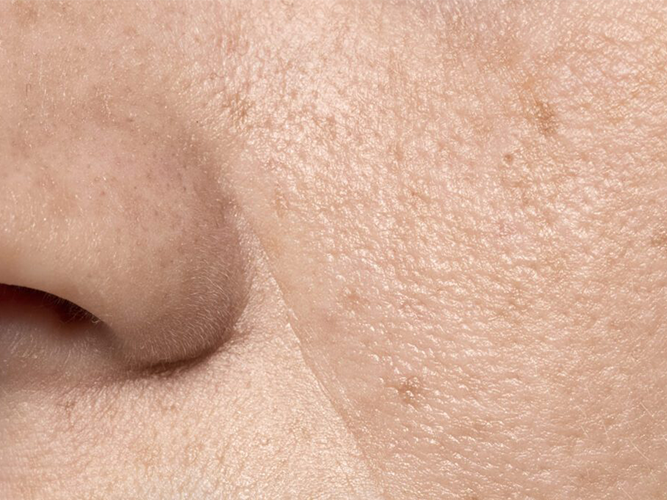 Scars and pores (Acne scars and enlarged pores)