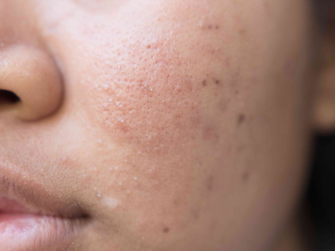 Uneven skin texture, Dull Skin