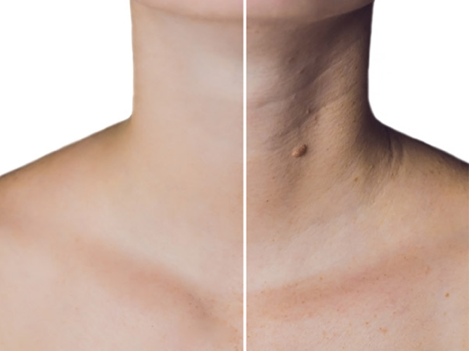 Neck line